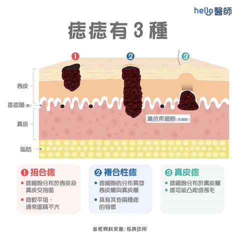 痣的形成原因|痣變大、痣多或長毛會變皮膚癌？認識痣的形成與原因